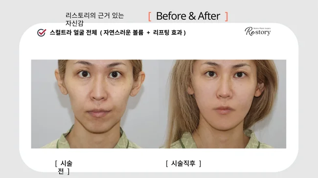 Full-face Sculptra · 112 at Restory Plastic Surgery Clinic. Front view. Before on the left; after on the right. The photographs show the shape and surface of the area named in the treatment. The after photograph is labelled immediately after treatment.