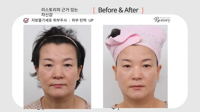 Stem-cell skin injections: facial comparison · 114 at Restory Plastic Surgery Clinic. Front view. Before on the left; after on the right. The photographs show the skin surface and folds in the photographed area. The follow-up interval is not stated.