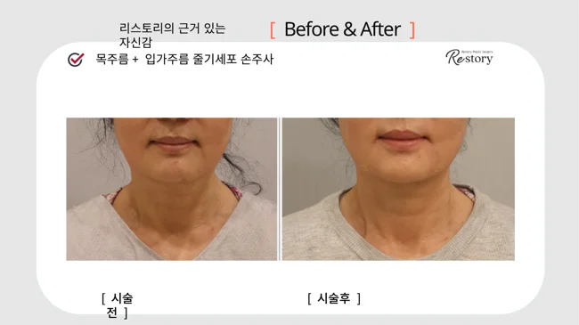 Stem-cell injections: neck and mouth-area lines · 115 at Restory Plastic Surgery Clinic. Neck and lower-face view. Before on the left; after on the right. The photographs show the skin surface and folds in the photographed area. The follow-up interval is not stated.