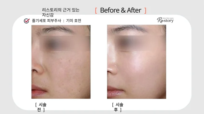 Stem-cell skin injections: cheek pigmentation comparison · 116 at Restory Plastic Surgery Clinic. Angled cheek close-up. Before on the left; after on the right. The photographs show the skin surface and folds in the photographed area. The follow-up interval is not stated.