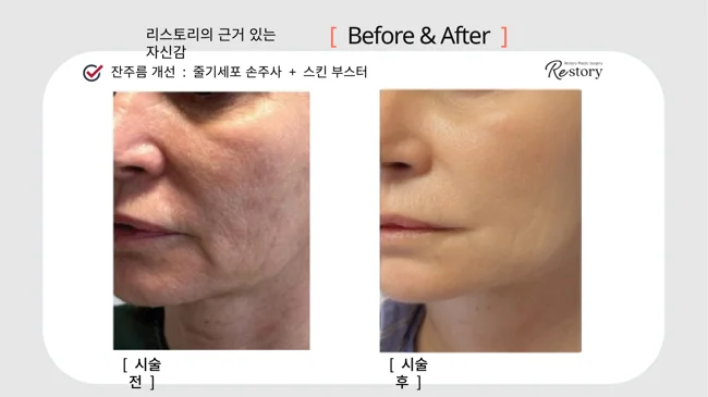 Stem-cell injections and skin booster: cheek close-up · 117 at Restory Plastic Surgery Clinic. Cheek close-up. Before on the left; after on the right. The photographs show the skin surface and folds in the photographed area. The follow-up interval is not stated.