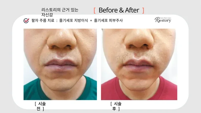 Stem-cell fat grafting and skin injections: mouth-area folds · 118 at Restory Plastic Surgery Clinic. Mouth-area close-up. Before on the left; after on the right. The photographs show the skin surface and folds in the photographed area. The follow-up interval is not stated.