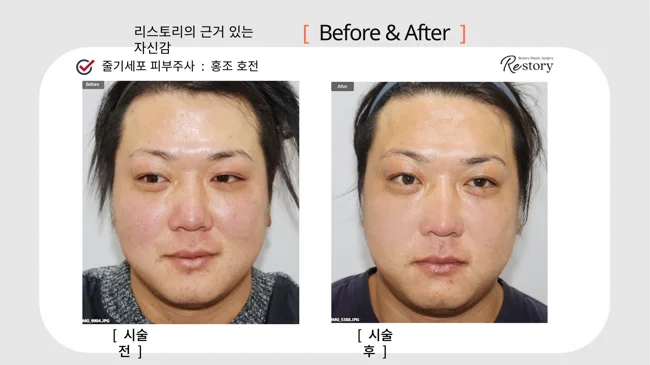 Stem-cell skin injections: facial redness comparison · 119 at Restory Plastic Surgery Clinic. Front view. Before on the left; after on the right. The photographs show the skin surface and folds in the photographed area. The follow-up interval is not stated.