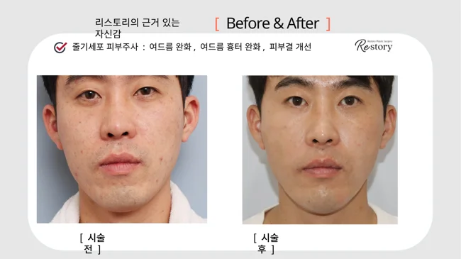Stem-cell skin injections: acne and skin-texture comparison · 120 at Restory Plastic Surgery Clinic. Front view. Before on the left; after on the right. The photographs show the skin surface and folds in the photographed area. The follow-up interval is not stated.
