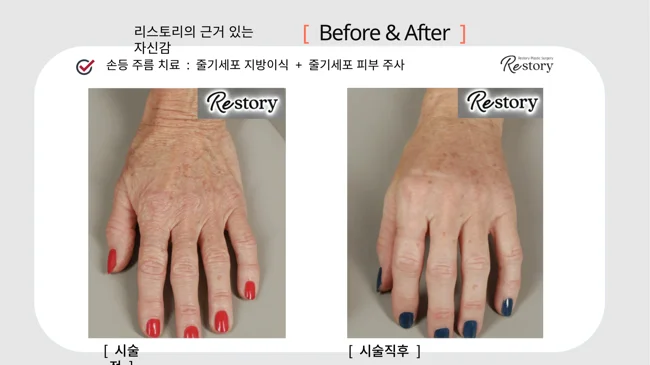Stem-cell fat grafting and injections: hand comparison · 121 at Restory Plastic Surgery Clinic. Back-of-hand view. Before on the left; after on the right. The photographs show the skin surface and folds in the photographed area. The after photograph is labelled immediately after treatment.