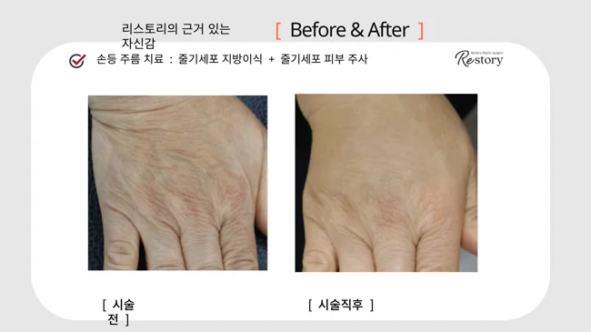 Stem-cell fat grafting and injections: hand close-up · 122 at Restory Plastic Surgery Clinic. Hand close-up. Before on the left; after on the right. The photographs show the skin surface and folds in the photographed area. The after photograph is labelled immediately after treatment.