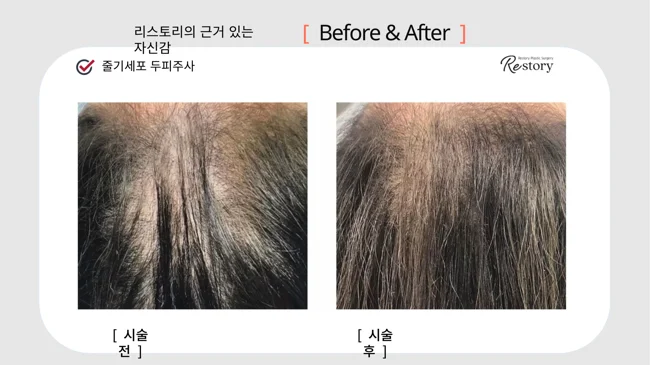 Stem-cell scalp injections: crown comparison · 123 at Restory Plastic Surgery Clinic. Crown of the scalp. Before on the left; after on the right. The photographs show the visible scalp and hair distribution around the crown. The follow-up interval is not stated.