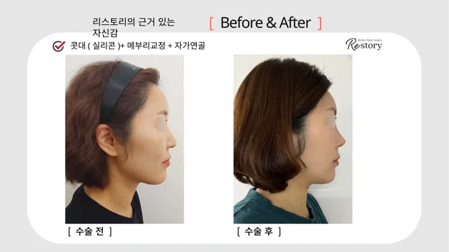 Rhinoplasty with silicone, hump correction and own cartilage · 125 at Restory Plastic Surgery Clinic. Side profile. Before on the left; after on the right. The photographs show the nasal bridge, tip and relationship of the nose to the face. The follow-up interval is not stated.