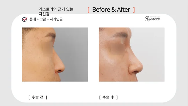 Nasal bridge and tip surgery with own cartilage · 126 at Restory Plastic Surgery Clinic. Nasal side close-up. Before on the left; after on the right. The photographs show the nasal bridge, tip and relationship of the nose to the face. The follow-up interval is not stated.