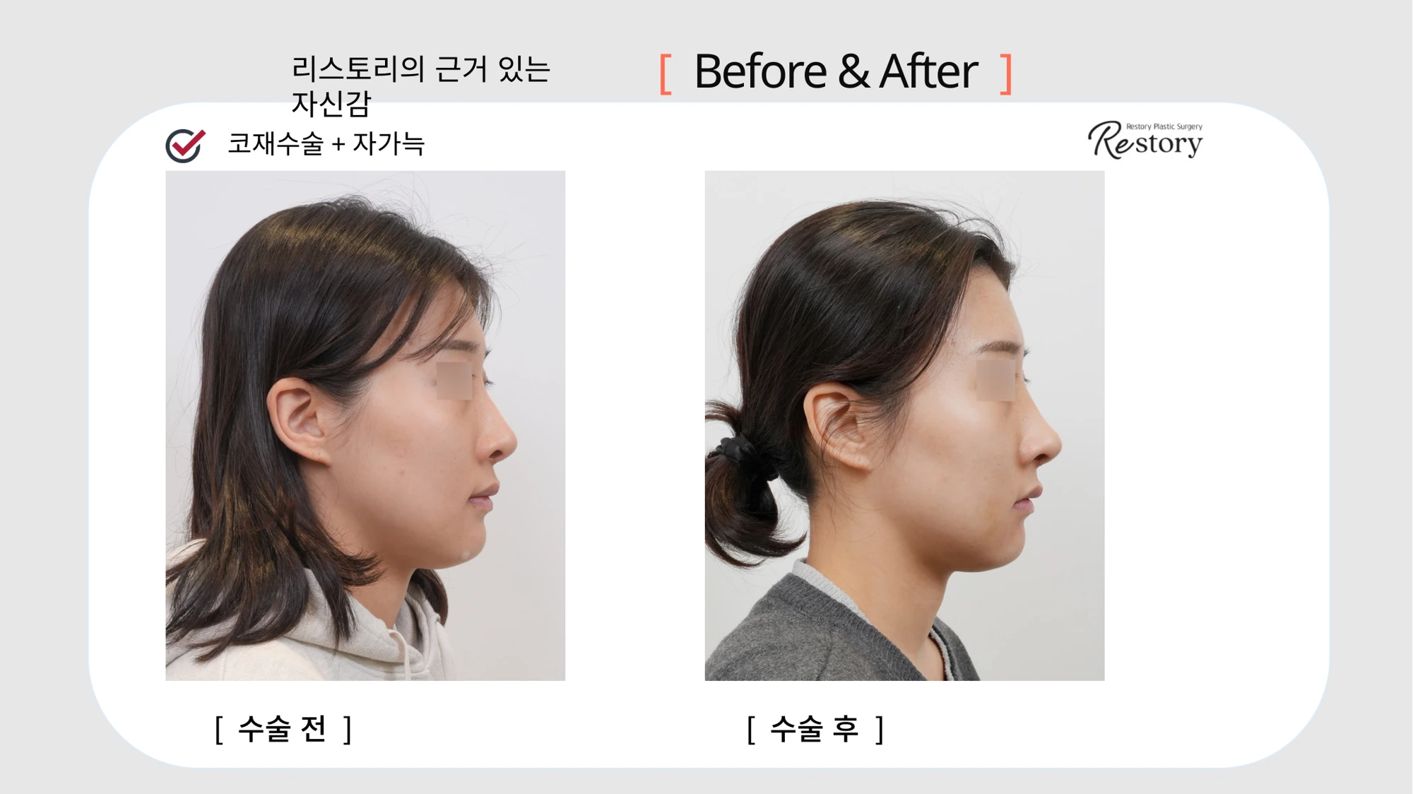 Revision rhinoplasty with own rib cartilage · 127 at Restory Plastic Surgery Clinic. Side profile. Before on the left; after on the right. The photographs show the nasal bridge, tip and relationship of the nose to the face. The follow-up interval is not stated.