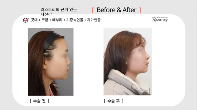 Bridge, tip and hump correction with donor and own cartilage · 128 at Restory Plastic Surgery Clinic. Side profile. Before on the left; after on the right. The photographs show the nasal bridge, tip and relationship of the nose to the face. The follow-up interval is not stated.