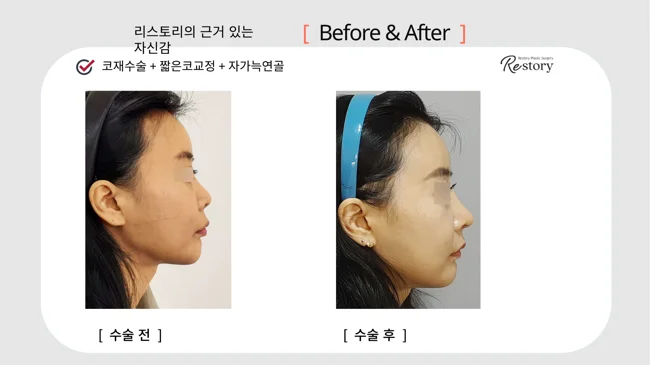 Short-nose revision with own rib cartilage · 129 at Restory Plastic Surgery Clinic. Side profile. Before on the left; after on the right. The photographs show the nasal bridge, tip and relationship of the nose to the face. The follow-up interval is not stated.