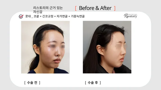 Long-nose correction with donor and own cartilage · 130 at Restory Plastic Surgery Clinic. Angled view. Before on the left; after on the right. The photographs show the nasal bridge, tip and relationship of the nose to the face. The follow-up interval is not stated.