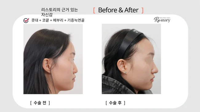 Bridge, tip and hump correction with donor rib cartilage · 131 at Restory Plastic Surgery Clinic. Side profile. Before on the left; after on the right. The photographs show the nasal bridge, tip and relationship of the nose to the face. The follow-up interval is not stated.