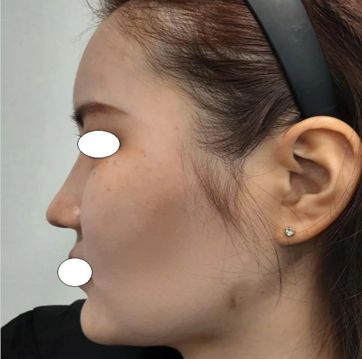Double-chin thread lift: side profile at Samsung B&S Clinic. Samsung B&S Clinic, Seoul — double-chin thread lift: side profile, after treatment.