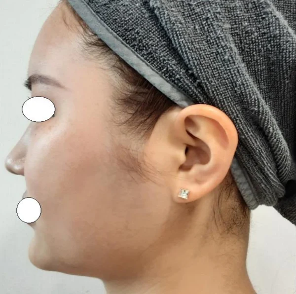 Double-chin thread lift: side profile at Samsung B&S Clinic. Samsung B&S Clinic, Seoul — double-chin thread lift: side profile, before treatment.