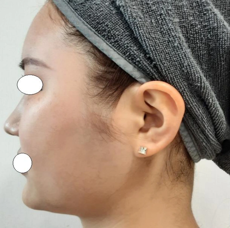 Double-chin thread lift: side profile at Samsung B&S Clinic. Samsung B&S Clinic, Seoul — double-chin thread lift: side profile, before treatment.