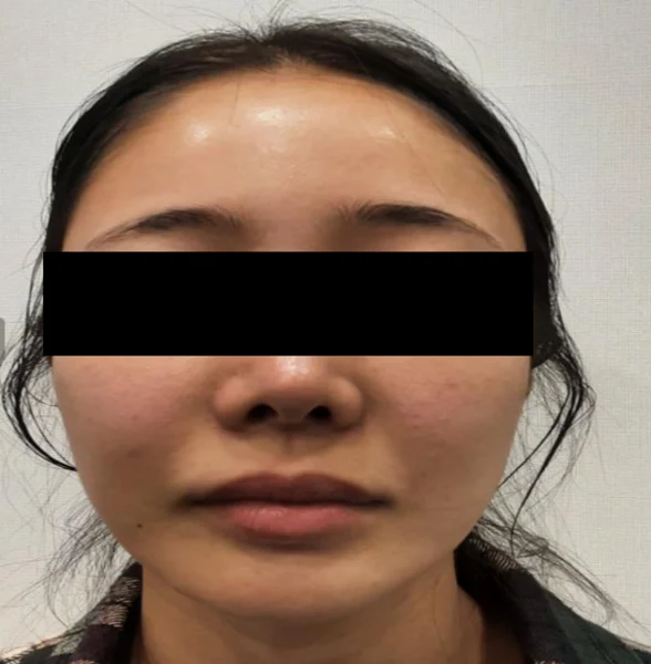 Thread lift: front-facing comparison at Samsung B&S Clinic. Samsung B&S Clinic, Seoul — thread lift: front-facing comparison, before treatment.