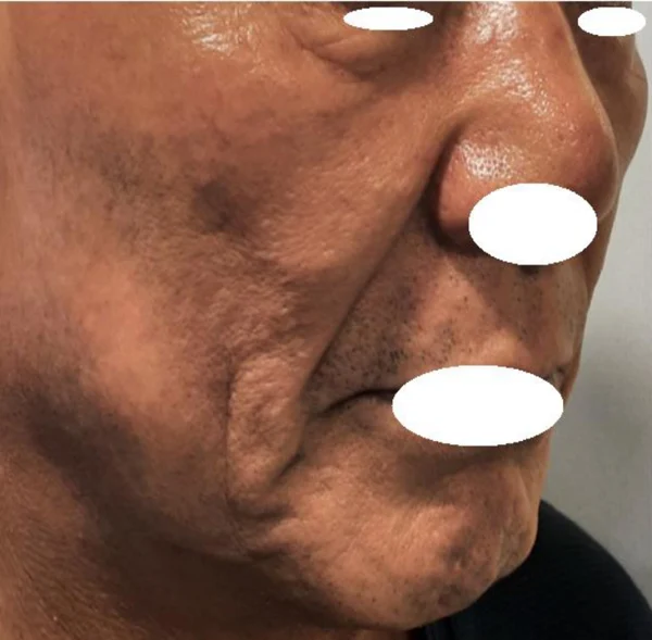 Thread lift, fillers and skin boosters: cheek comparison at Samsung B&S Clinic. Samsung B&S Clinic, Seoul — thread lift, fillers and skin boosters: cheek comparison, before treatment.