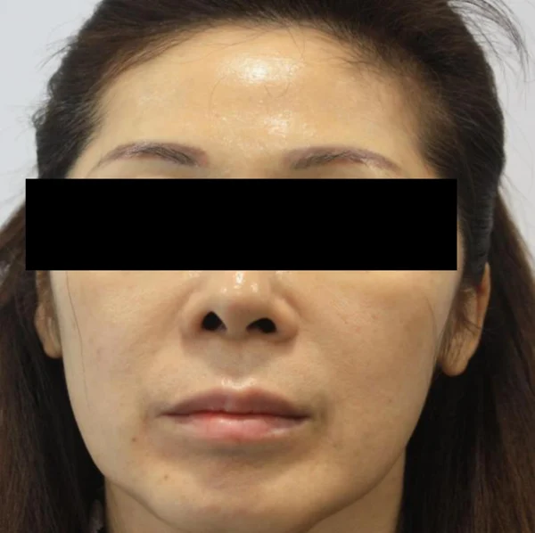 Jamber threads for the front cheeks and facial lifting at Samsung B&S Clinic. Samsung B&S Clinic, Seoul — jamber threads for the front cheeks and facial lifting, before treatment.