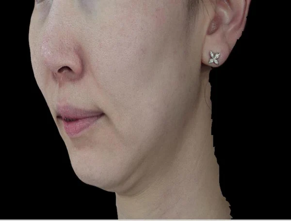 Mid-cheek grooves, nasolabial folds and side cheeks at Samsung B&S Clinic. Samsung B&S Clinic, Seoul — mid-cheek grooves, nasolabial folds and side cheeks, before treatment.