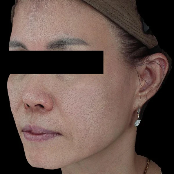 Thread lift: oblique cheek and jaw views at Samsung B&S Clinic. Samsung B&S Clinic, Seoul — thread lift: oblique cheek and jaw views, before treatment.