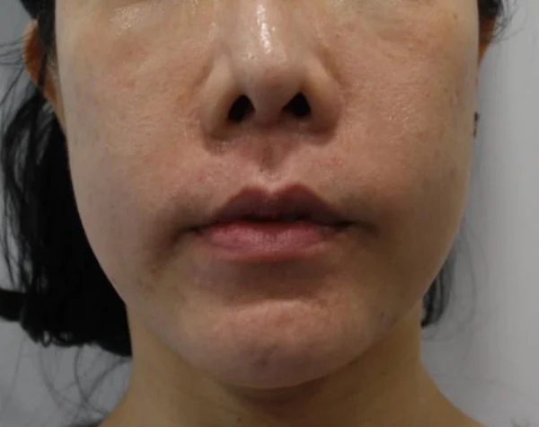 Thread lift: lower-face close-up at Samsung B&S Clinic. Samsung B&S Clinic, Seoul — thread lift: lower-face close-up, before treatment.