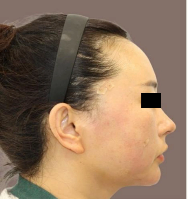 Nose thread lift: right-facing profile at Samsung B&S Clinic. Samsung B&S Clinic, Seoul — nose thread lift: right-facing profile, after treatment.