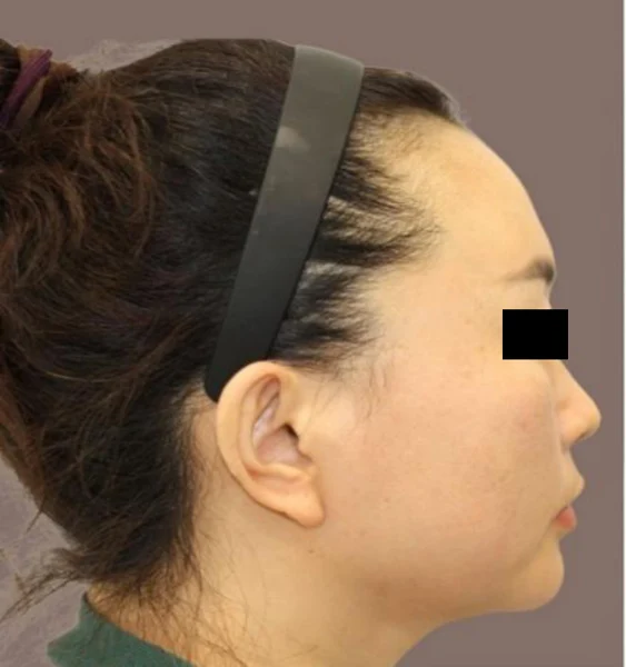 Nose thread lift: right-facing profile at Samsung B&S Clinic. Samsung B&S Clinic, Seoul — nose thread lift: right-facing profile, before treatment.