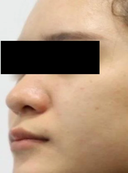 Nose thread lift: left-facing profile at Samsung B&S Clinic. Samsung B&S Clinic, Seoul — nose thread lift: left-facing profile, before treatment.