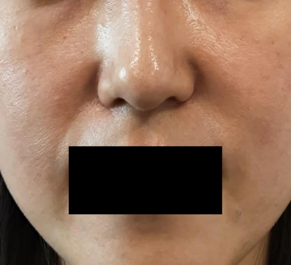 Jamber threads for nasolabial folds at Samsung B&S Clinic. Samsung B&S Clinic, Seoul — jamber threads for nasolabial folds, before treatment.
