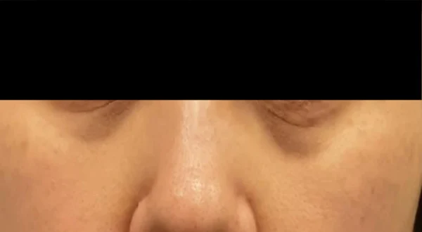 Jamber threads for the under-eye area at Samsung B&S Clinic. Samsung B&S Clinic, Seoul — jamber threads for the under-eye area, before treatment.