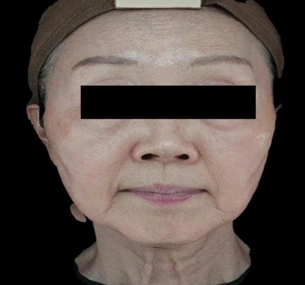 Nasolabial folds and marionette lines: full-face views at Samsung B&S Clinic. Samsung B&S Clinic, Seoul — nasolabial folds and marionette lines: full-face views, before treatment.