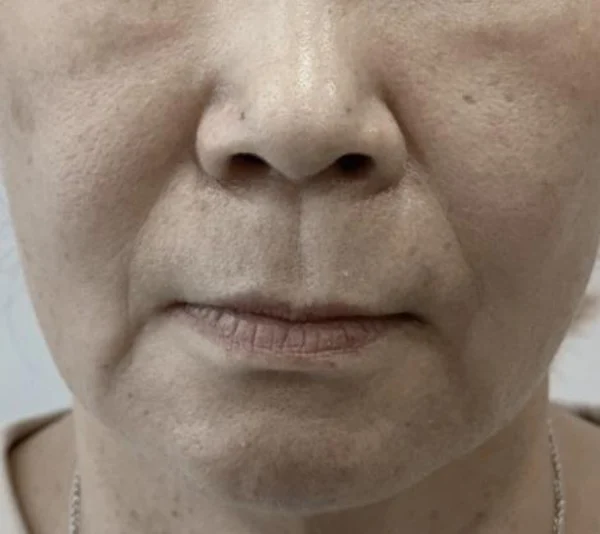 Nasolabial folds and marionette lines: lower-face detail at Samsung B&S Clinic. Samsung B&S Clinic, Seoul — nasolabial folds and marionette lines: lower-face detail, before treatment.
