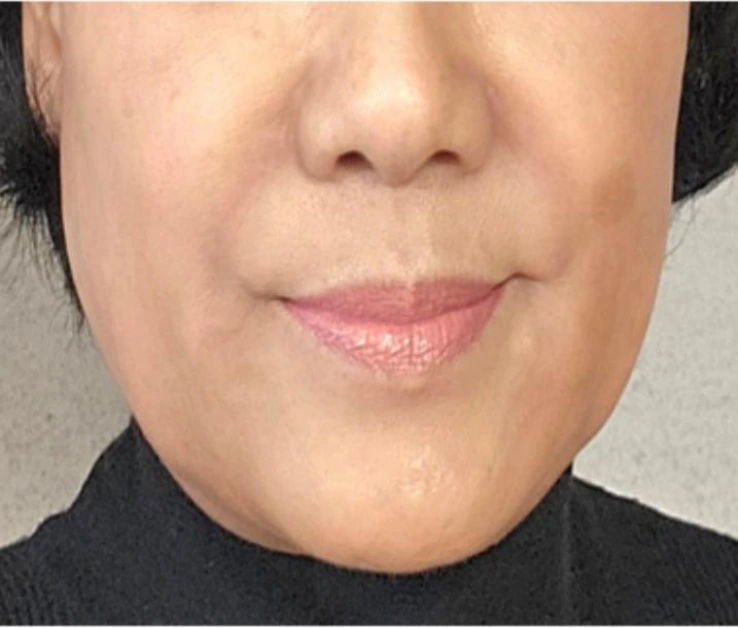 Nasolabial folds: mouth and cheek comparison at Samsung B&S Clinic. Samsung B&S Clinic, Seoul — nasolabial folds: mouth and cheek comparison, after treatment.