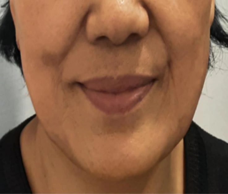 Nasolabial folds: mouth and cheek comparison at Samsung B&S Clinic. Samsung B&S Clinic, Seoul — nasolabial folds: mouth and cheek comparison, before treatment.