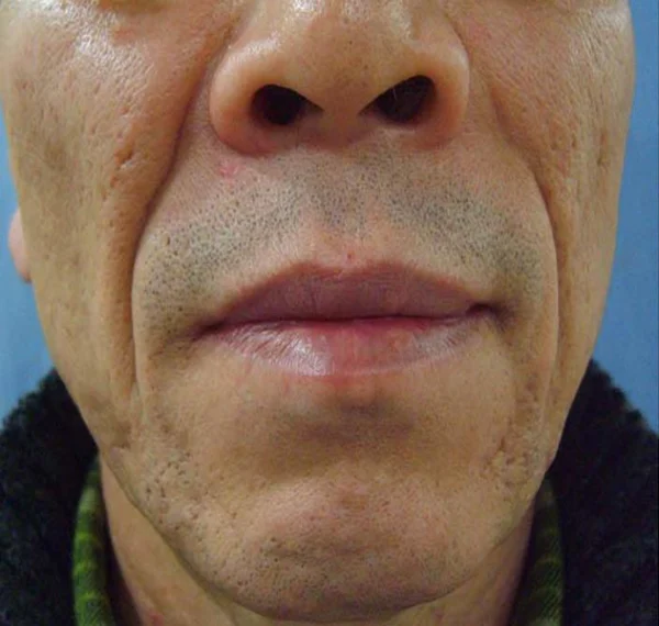 Nasolabial folds with thread lifting at Samsung B&S Clinic. Samsung B&S Clinic, Seoul — nasolabial folds with thread lifting, before treatment.