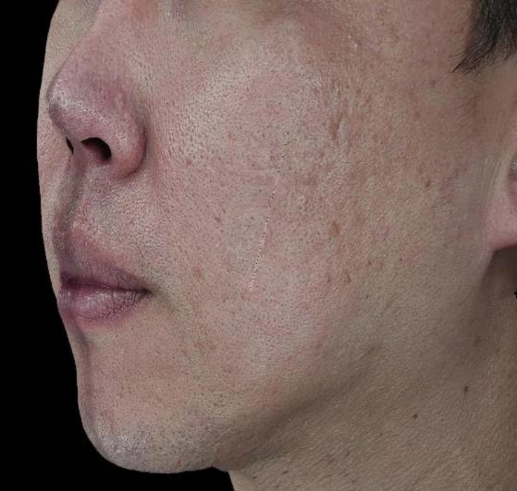 Acne scars: oblique cheek comparison at Samsung B&S Clinic. Samsung B&S Clinic, Seoul — acne scars: oblique cheek comparison, after treatment.
