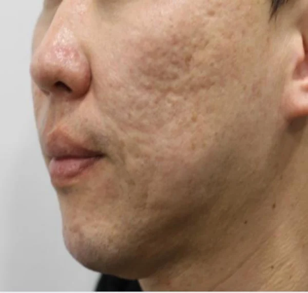 Acne scars: oblique cheek comparison at Samsung B&S Clinic. Samsung B&S Clinic, Seoul — acne scars: oblique cheek comparison, before treatment.