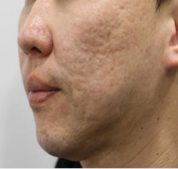 Acne scars: oblique cheek comparison at Samsung B&S Clinic. Samsung B&S Clinic, Seoul — acne scars: oblique cheek comparison, before treatment.