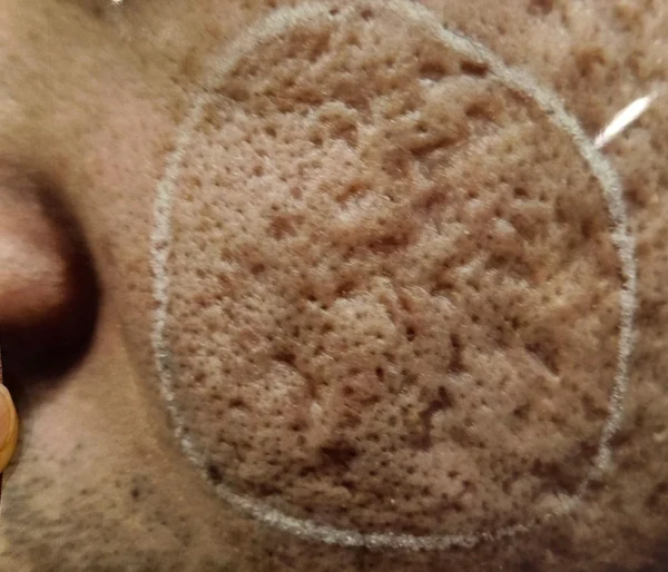 Scars: close-up cheek texture at Samsung B&S Clinic. Samsung B&S Clinic, Seoul — scars: close-up cheek texture, before treatment.