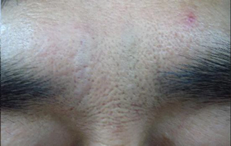 Brow furrow: glabellar line comparison at Samsung B&S Clinic. Samsung B&S Clinic, Seoul — brow furrow: glabellar line comparison, after treatment.