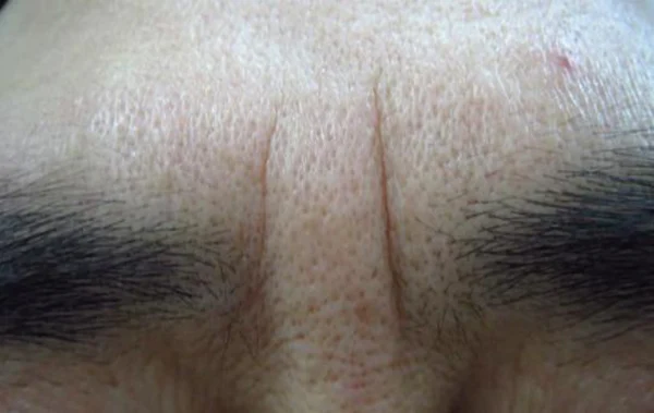 Brow furrow: glabellar line comparison at Samsung B&S Clinic. Samsung B&S Clinic, Seoul — brow furrow: glabellar line comparison, before treatment.