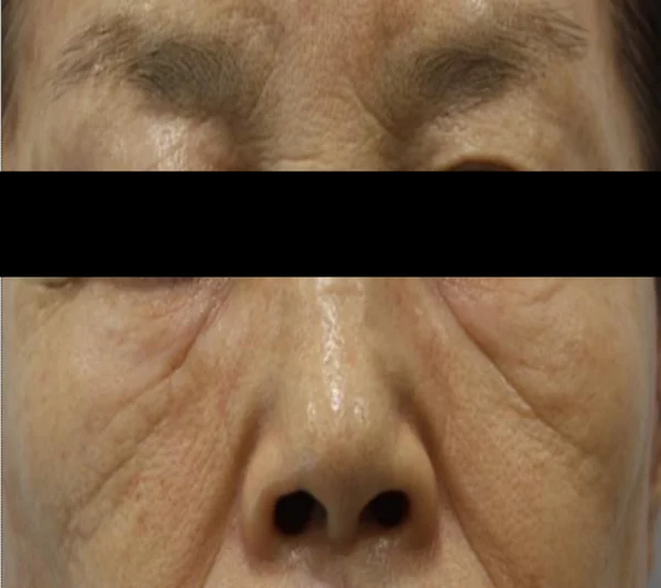 Mid-cheek grooves: front-facing detail at Samsung B&S Clinic. Samsung B&S Clinic, Seoul — mid-cheek grooves: front-facing detail, before treatment.