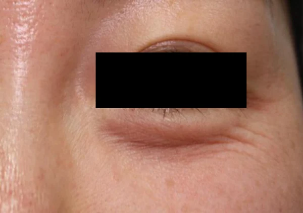 Eye-area lines: close-up comparison at Samsung B&S Clinic. Samsung B&S Clinic, Seoul — eye-area lines: close-up comparison, before treatment.