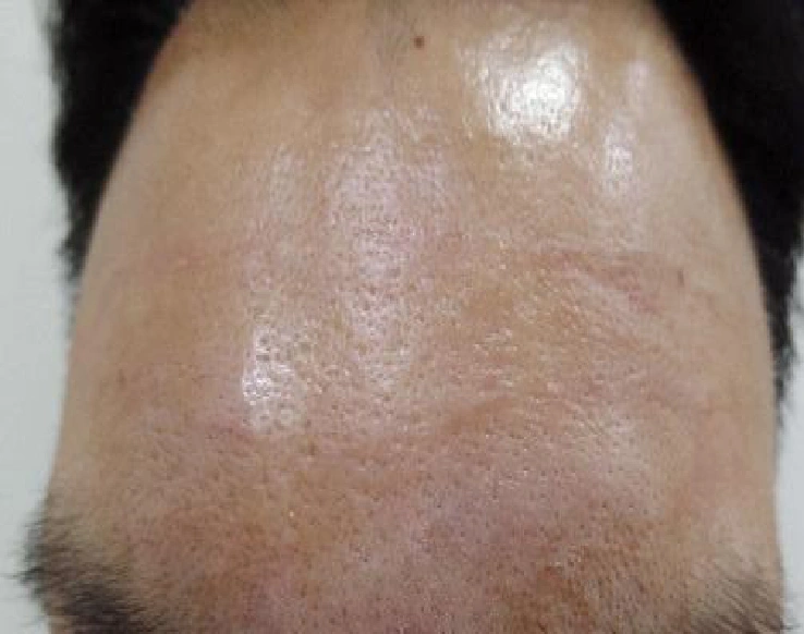 Forehead wrinkles: close-up comparison at Samsung B&S Clinic. Samsung B&S Clinic, Seoul — forehead wrinkles: close-up comparison, after treatment.