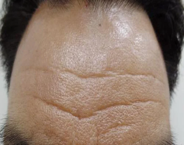 Forehead wrinkles: close-up comparison at Samsung B&S Clinic. Samsung B&S Clinic, Seoul — forehead wrinkles: close-up comparison, before treatment.