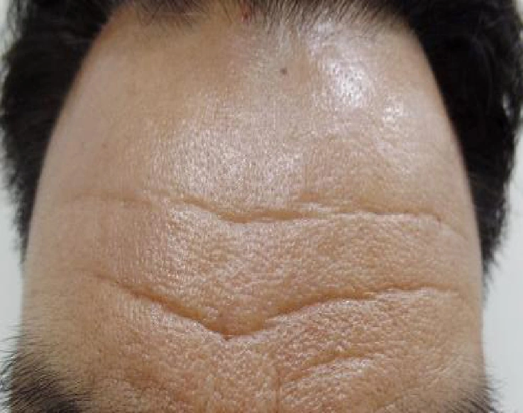 Forehead wrinkles: close-up comparison at Samsung B&S Clinic. Samsung B&S Clinic, Seoul — forehead wrinkles: close-up comparison, before treatment.
