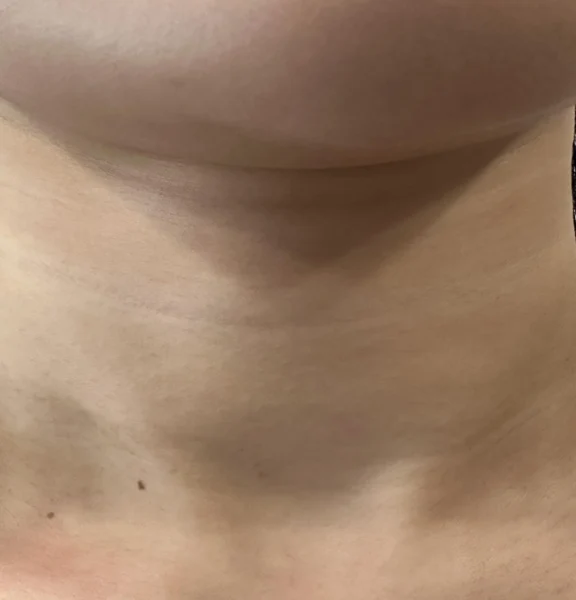 Neck lines: front-facing comparison at Samsung B&S Clinic. Samsung B&S Clinic, Seoul — neck lines: front-facing comparison, before treatment.