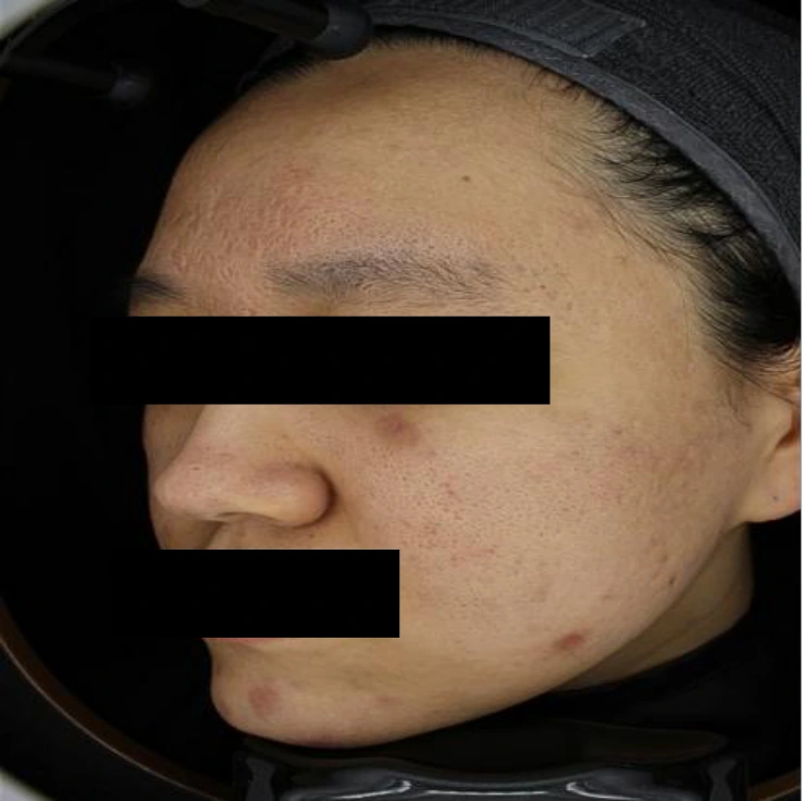 Skin boosters for acne scars: cheek views at Samsung B&S Clinic. Samsung B&S Clinic, Seoul — skin boosters for acne scars: cheek views, after treatment.